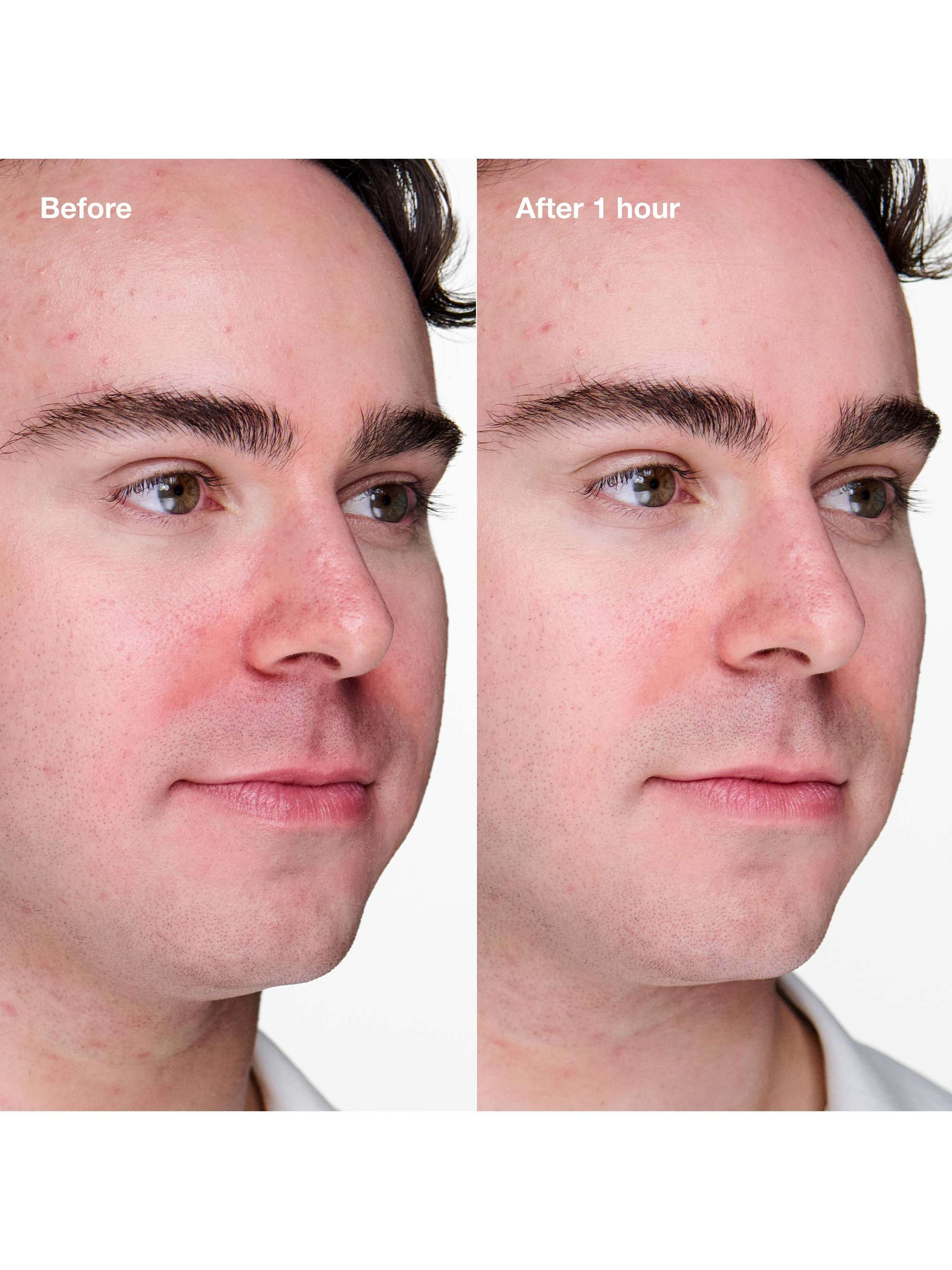 Anti-Blemish Solutions Clinical Advanced Clearing Gel